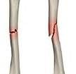 Переломы плечевой кости