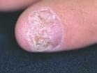 Заболевания ногтевой пластины