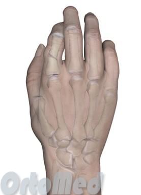 Лечение перелома пальцев руки фото