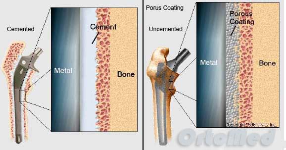 цементное и бесцементное эндопротезирование тазобедренного сустава