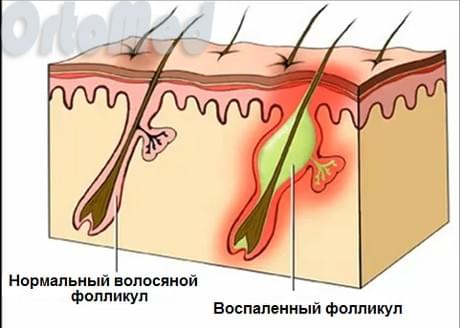 анатомия фурункулеза