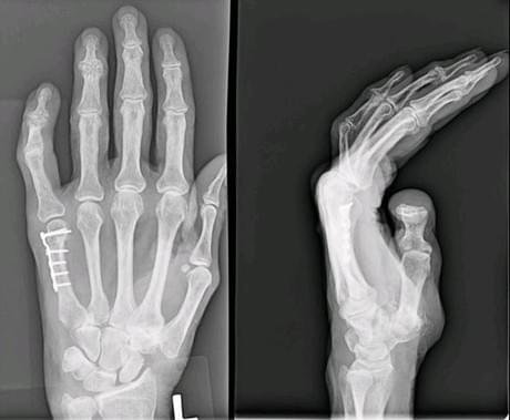 Восстановление кисти руки после перелома пястной кости