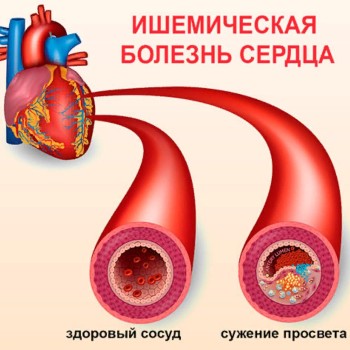 Ишемическая болезнь сердца - симптомы, лечение