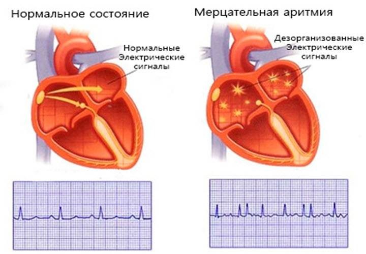 Причины развития мерцательной аритмии сердца