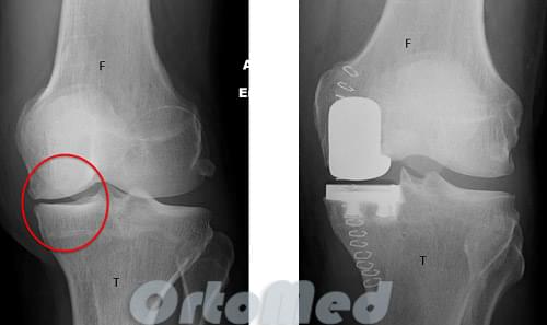 рентгенограмма после одномыщелкового эндопротезирования коленного сустава