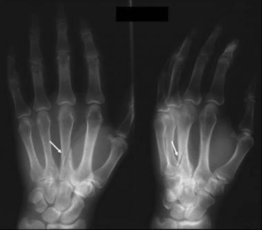 Перелом пястной кости движение пальцами thumbnail