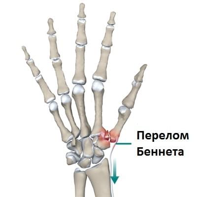 Операции после перелома пястных костей thumbnail