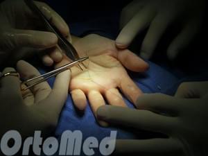 Лечение стенозирующего лигаментита (щелкающий палец)