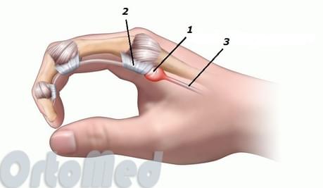 Синдром щелкающего пальца на руке, цены на лечение в Москве АРТ-Клиник