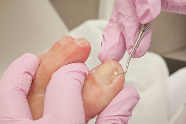 Лечение вросшего ногтя на ноге