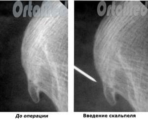 удаление пяточной шпоры под рентген контролем