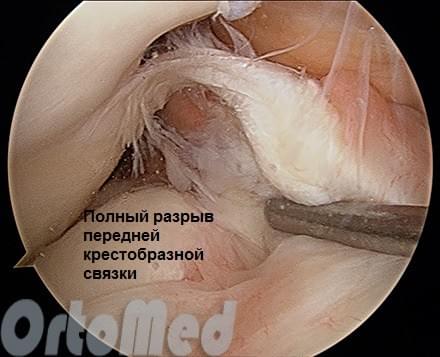 полный расрыв передней крестообраззной связки