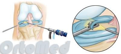 процесс артроскопии колена