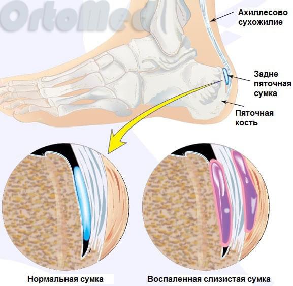 анатомия пяточной кости