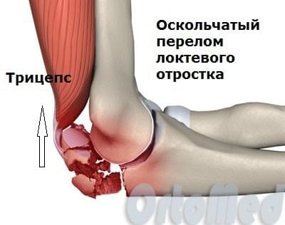 оскольчатый перелом локтевого отростка