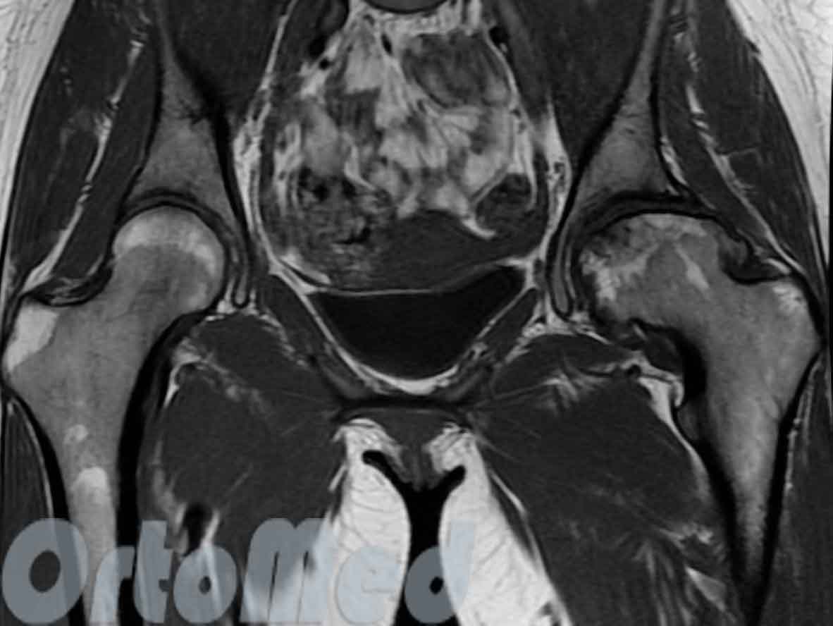 асептический некроз головки бедренной кости МРТ