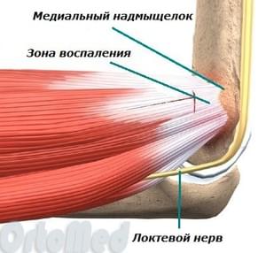 Медиальный эпикондилит локтевого сустава