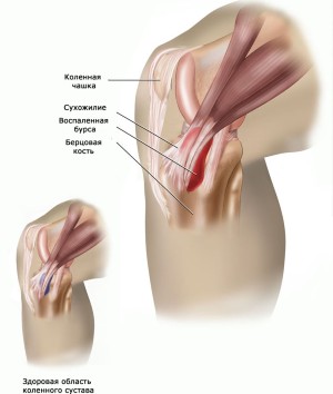 бурсит коленного сустава