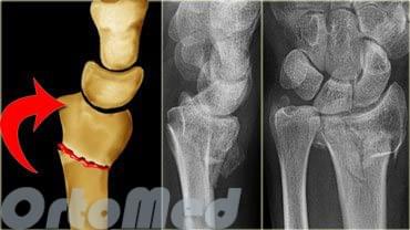 перелом лучевой кости руки