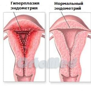 Гиперплазия эндометрия