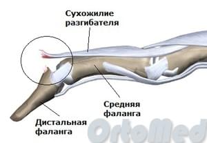 разрыв разгибателя