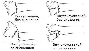 оскольчатый перелом лучевой кости со смещением