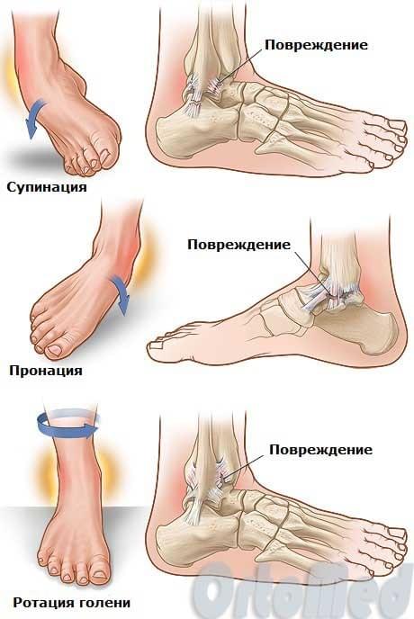 Травмы голеностопного сустава