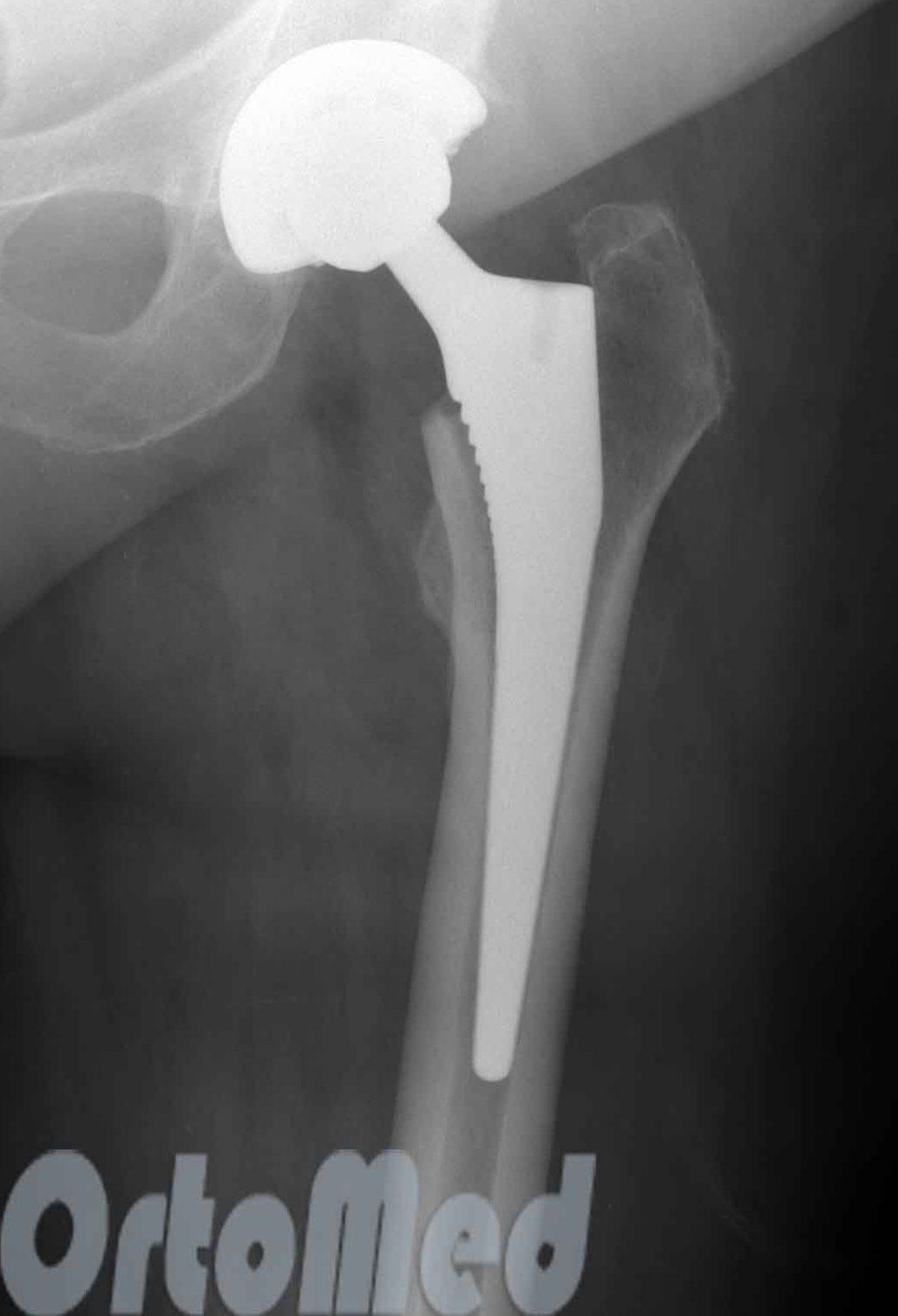 рентгенограмма после тотального эндопротезирования тазобедренного сустава