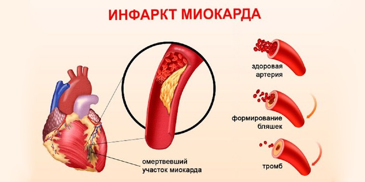 Инфаркт миокарда