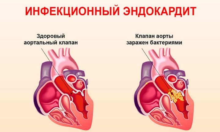 Инфекционный эндокардит