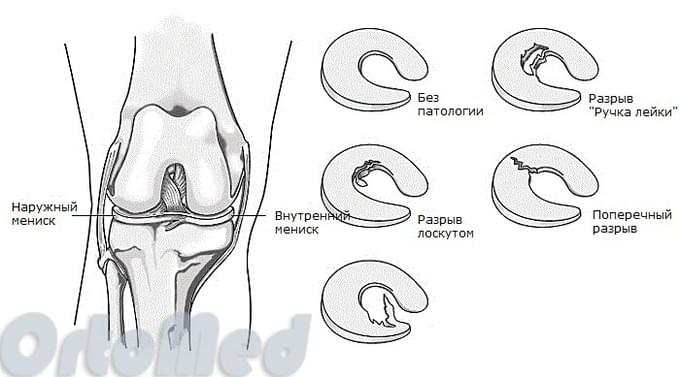 виды повреждения менисков