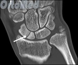 перелом ладьевидной кости в средней трети