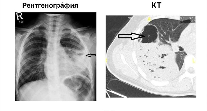 Абсцесс легкого лечение и симптомы