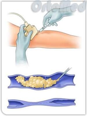 Пенная склеротерапия