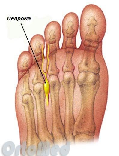 Неврома Мортона