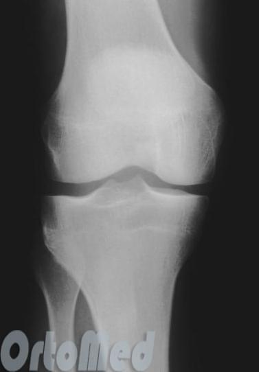 деформирующий артроз коленного сустава