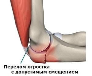 перелом локтевого отростка со смещением