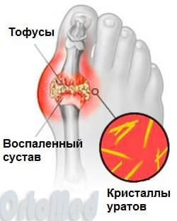 анатомия подагры