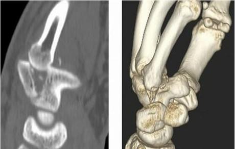перелом пястной кости