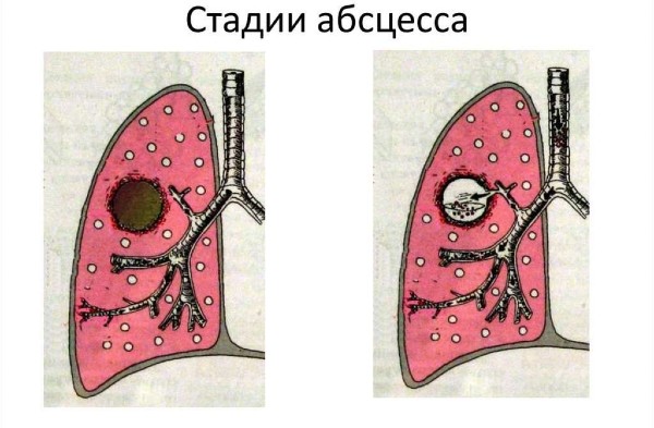 Абсцесс лёгкого стадии