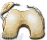 схематичное смещение надколенника
