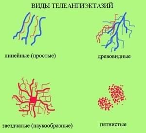 виды телеангиэктазии (сосудистых сеточек)